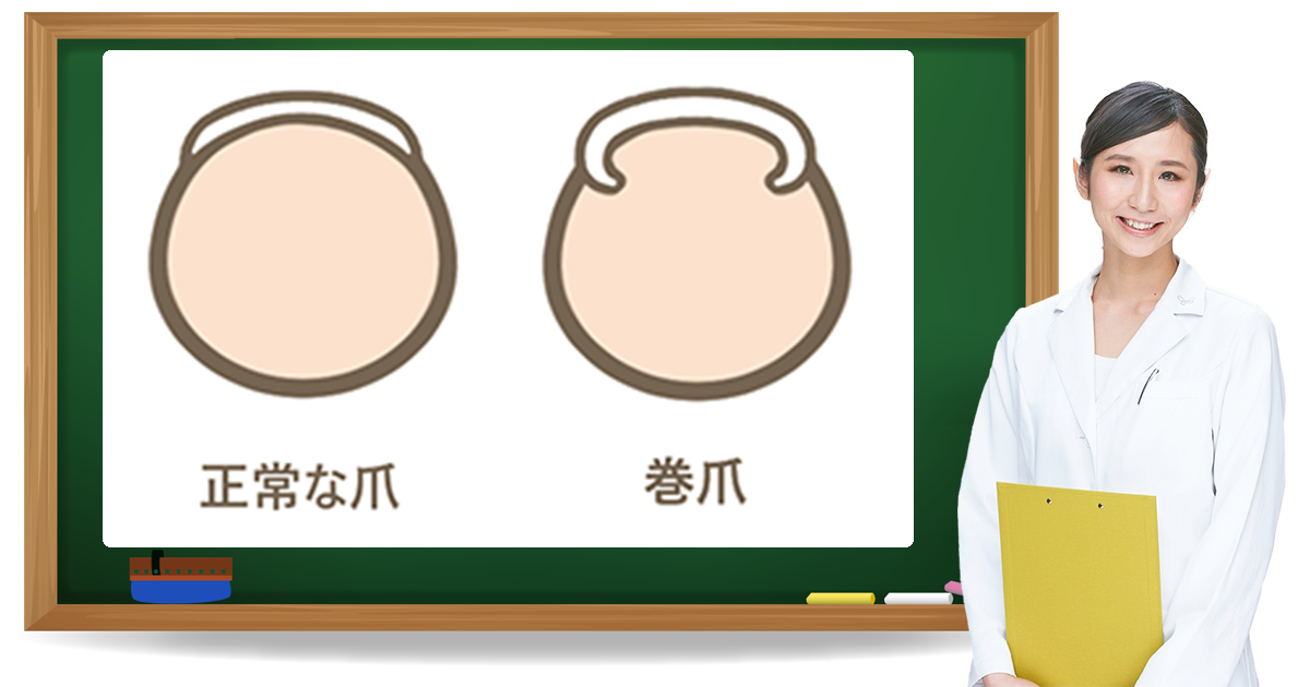 巻き爪とは?症状・原因・予防方法|フットケア推進室 巻き爪とは?症状・原因・予防方法|フットケア推進室
