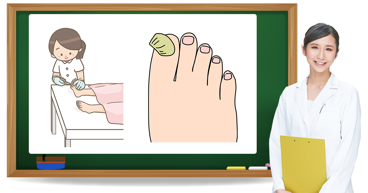 肥厚爪とは?症状・原因・予防方法|フットケア推進室 肥厚爪とは?症状・原因・予防方法|フットケア推進室