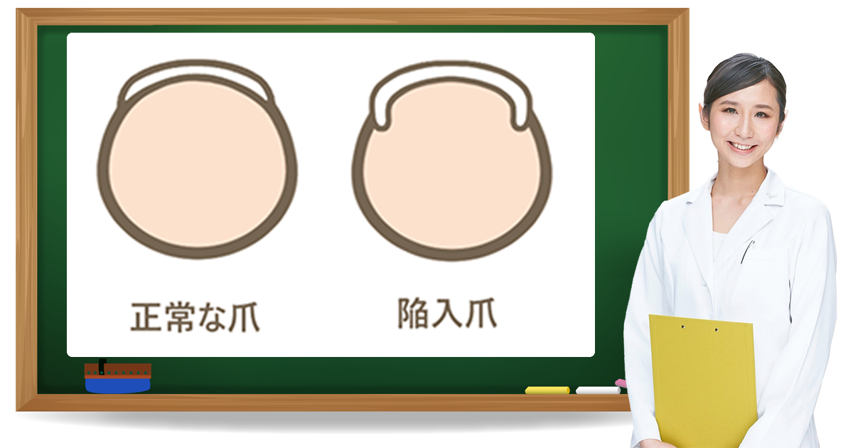 陥入爪とは?症状・原因・予防方法|フットケア推進室 陥入爪とは?症状・原因・予防方法|フットケア推進室