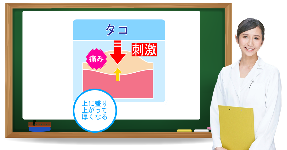 タコとは?症状・原因・予防方法|フットケア推進室 タコとは?症状・原因・予防方法|フットケア推進室